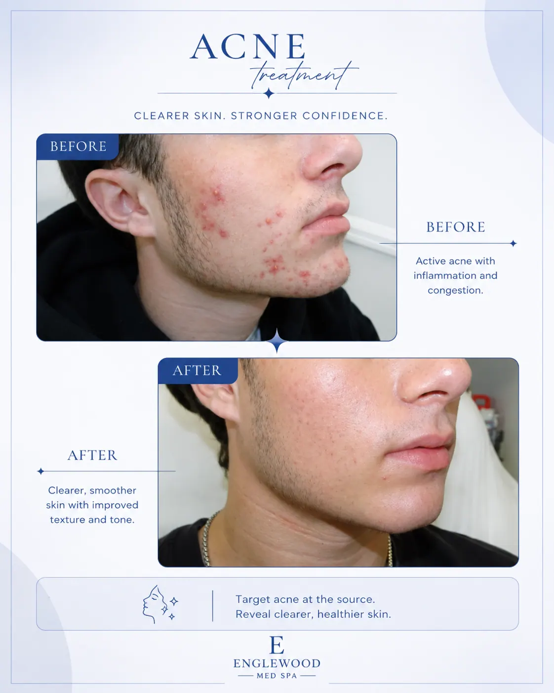 Before and after acne treatment for a male patient — Englewood Cosmetic Medical Spa