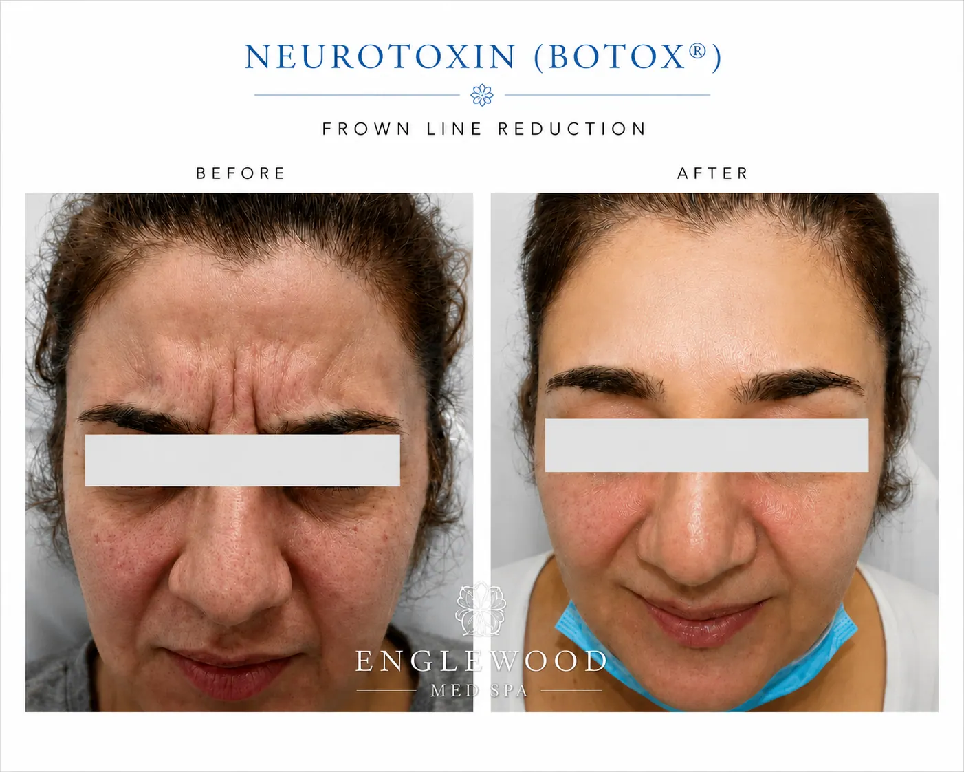 Before and after Botox frown line reduction — Englewood Cosmetic Medical Spa