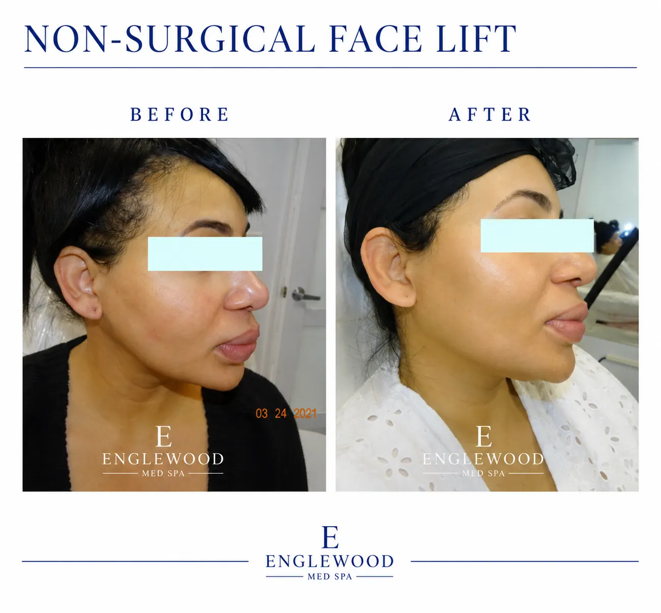 Before and after non-surgical face lift for jawline and skin tightening — Englewood Cosmetic Medical Spa, Englewood NJ