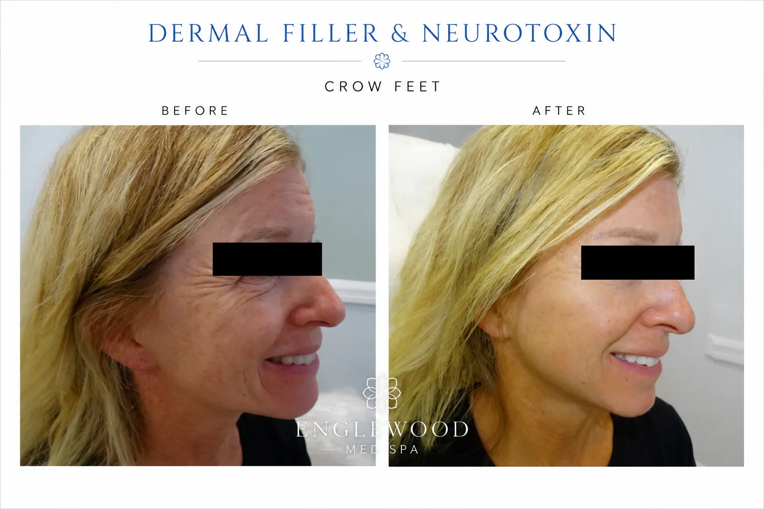 Before and after Botox and dermal filler crow's feet treatment — Englewood Cosmetic Medical Spa