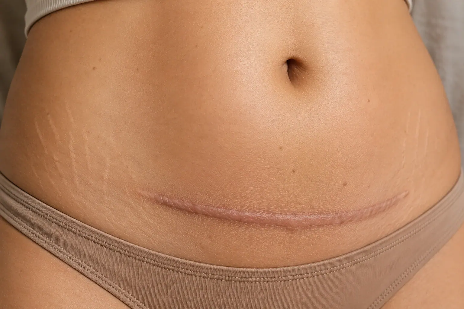 C-Section Scar Revision | Englewood Med Spa Close-up of a healed C-section scar with natural stretch marks demonstrating scar revision treatment concerns at Englewood Med Spa in Bergen County, New Jersey.