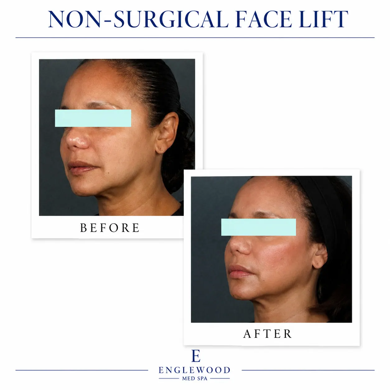 Before and after non-surgical face lift for skin tightening — Englewood Cosmetic Medical Spa, Englewood NJ