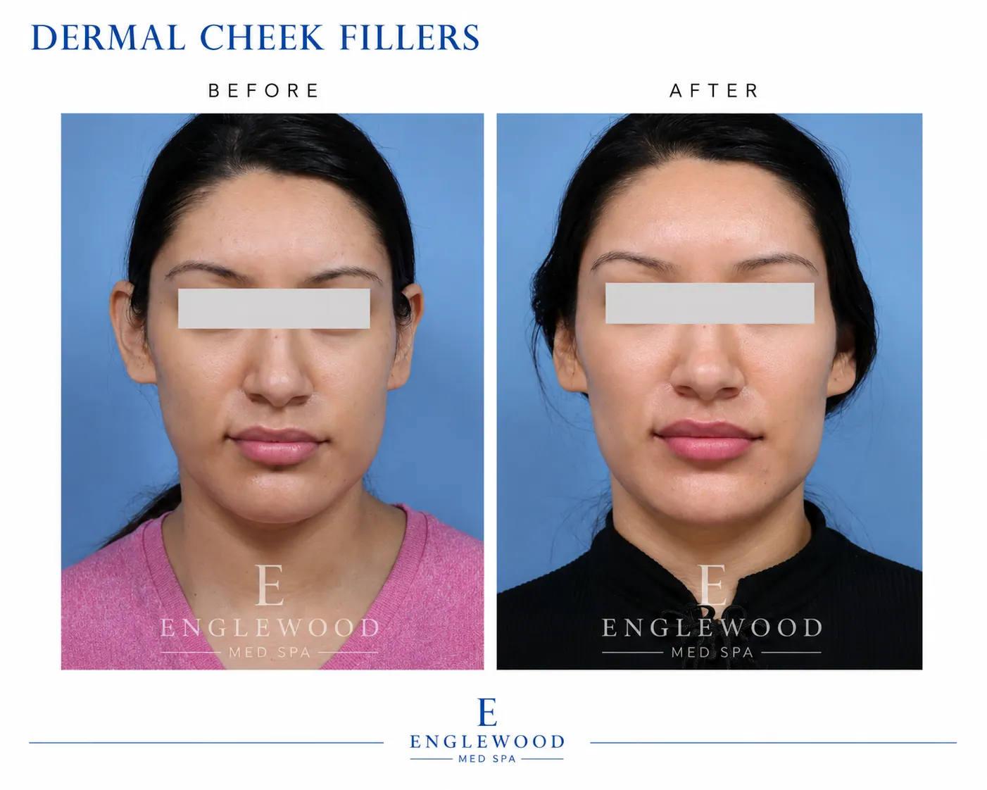 Before and after dermal cheek filler — Englewood Cosmetic Medical Spa, Englewood NJ