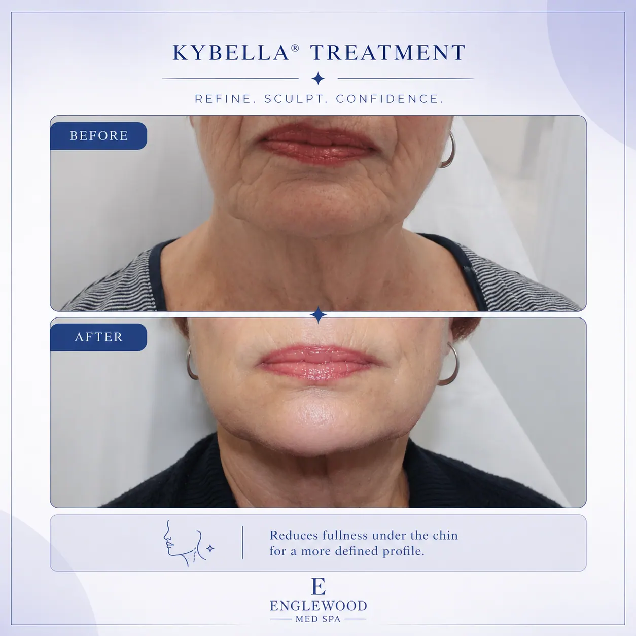 Before and after Kybella under-chin fat reduction — Englewood Cosmetic Medical Spa